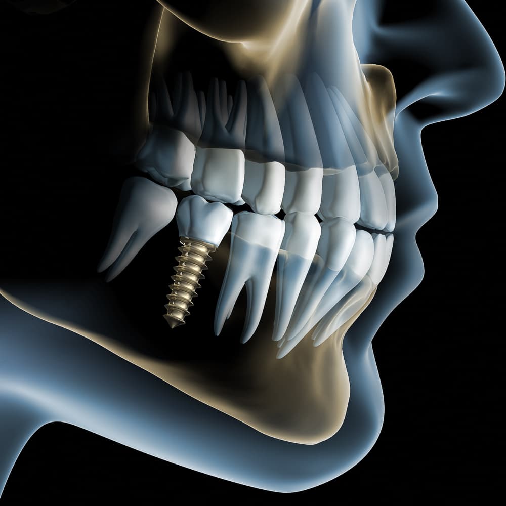 Implantat Planung